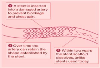 Best Hospitals For Bioresorbable Vascular Scaffold Procedure In Delhi