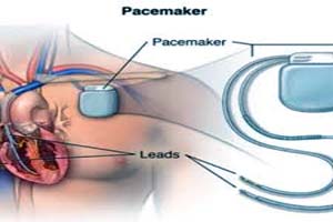 Best Hospitals for Cardiac Pacemaker Surgery