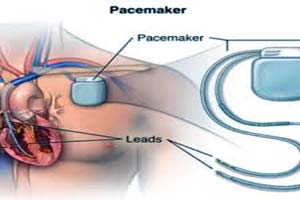 কার্ডিয়াক পেসমেকার সার্জারির জন্য সেরা হাসপাতাল