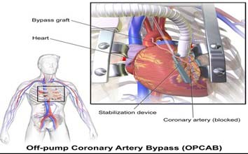 Meilleurs hôpitaux pour la chirurgie cardiaque hors pompe en Inde