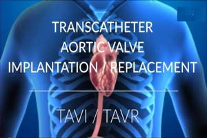 Best Hospitals For Trans Catheter Aortic Valve Implantation Tavi In India