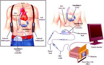 Best Surgeons For VAD Procedure In India