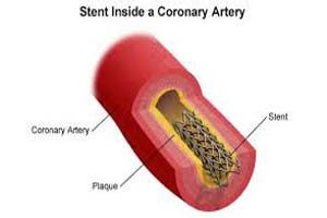 Bvs Stent Cost In India