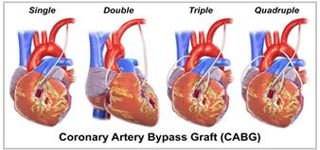 CABG Surgery in India