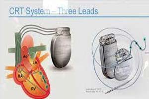 Cardiac Resynchronization Therapy at Top Hospital in India