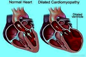 Cardiomegaly Treatment at Top Hospital in India