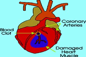 Coronary Heart Diseases in India