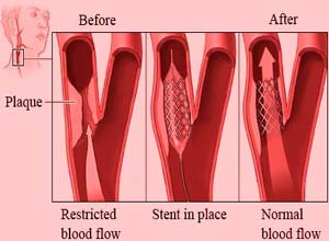 Avantages coûts de la chirurgie d'angioplastie en Inde