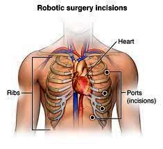 Cost Benefits of Robotic Cardiac Surgery in India