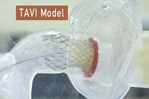 Coût Pour Tavi (Implantation De La Valve Aortique Transcatheter) À Delhi