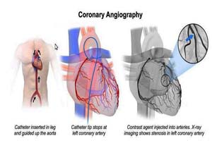 Cost of Coronary Angiography India