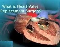 chirurgie de remplacement de la valve cardiaque en Inde