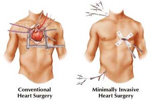 cost of minimally invasive heart surgery in india