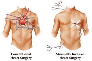 coût de la chirurgie cardiaque mini-invasive en Inde