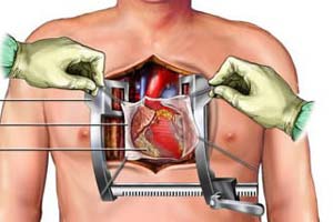 Cost of Open Heart Surgery In India