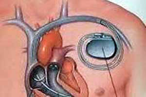 Cost of Pacemaker Implant Surgery In India