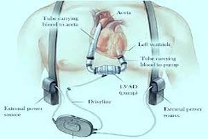Cost of Ventricular Assist Device India