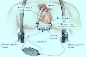 ভেন্ট্রিকুলার সহায়তা ডিভাইস ভারতের দাম ভারত