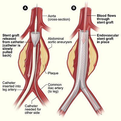 evar procedure