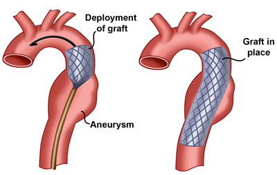 evar procedure