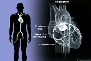 Coût du test d'angiographie coronaire en Inde