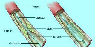 Angioplastie à faible coût en Inde