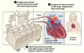 Low Cost Artifical Heart Transplant in India