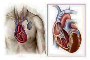 Low Cost Cardiac Resynchronization Therapy in India
