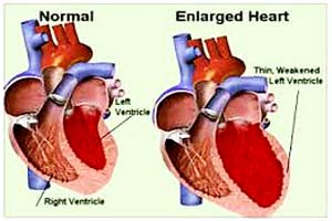 Low Cost Cardiomegaly Treatment in India