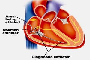 Low Cost Catheter Ablation Procedure in India