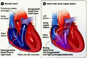 Low Cost Congenital Atrial Septal Defects (asd) Surgery in India