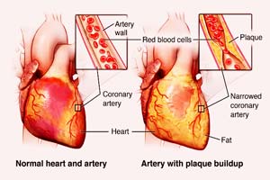 Low Cost Coronary Heart Disease Treatment in India