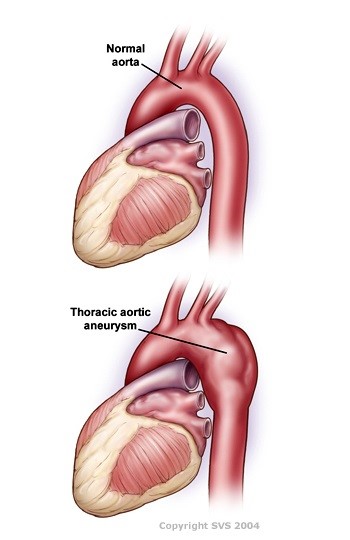 low cost endovascular aneurysm repair best cardiac surgery india
