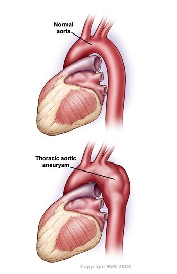 réparation anévrisme endovasculaire à faible coût meilleure chirurgie en Inde Inde