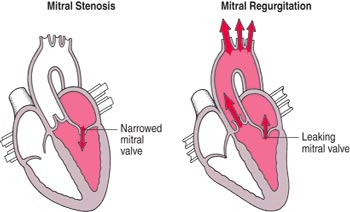 Low Cost Heart Valve Repair In India