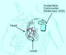 Low Cost ICD Implantation India