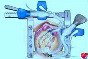 Chirurgie cardiaque hors pompe à faible coût en Inde