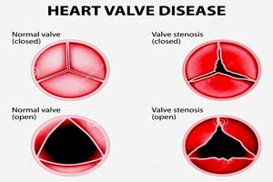 Low Cost Rheumatic Heart Disease Treatment in India