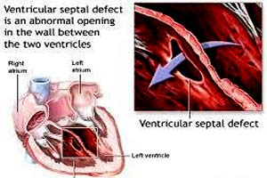 Low Cost Ventricular Septal Defect Surgery in India