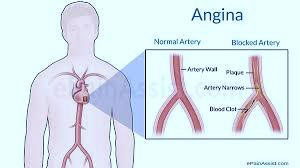 Price Of Angioplasty Surgery In India