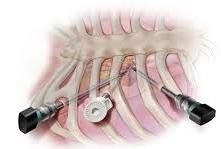 Minimally Invasive Heart Surgery Price of Mitral Valve Repair Surgery In India