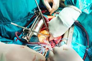 Price Of Open Heart Surgery In India