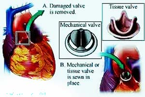 Rheumatic Heart disease causes