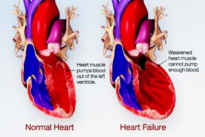 Rheumatic Heart Disease Treatments in India