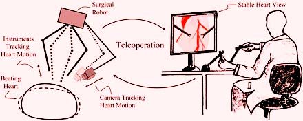 Chirurgie Cardiaque Robotique Inde