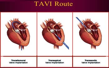 tavi cost in india