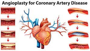 Top Angioplasty Hospitals In India