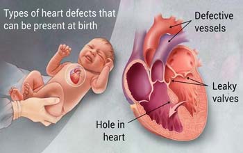 Top Congenital Heart Defects Hospitals In India