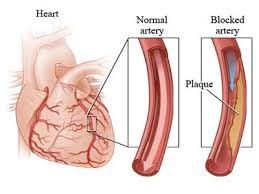 CABG en Inde