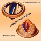 Top Hospitals for Valve Replacement Surgery In India